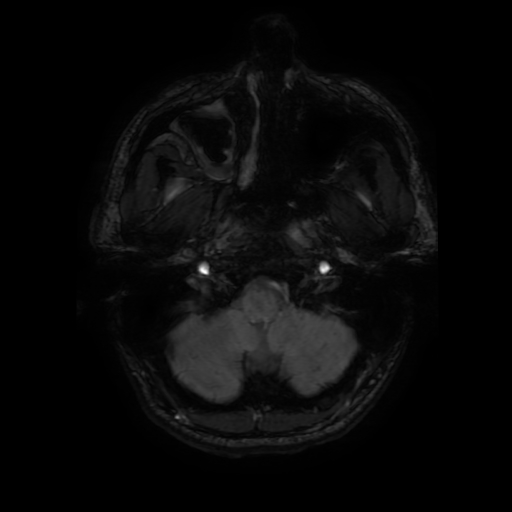 Cerebral cavernous venous malformation (Zabramski type II) (Radiopaedia 85511-101198 Axial SWI 18).jpg