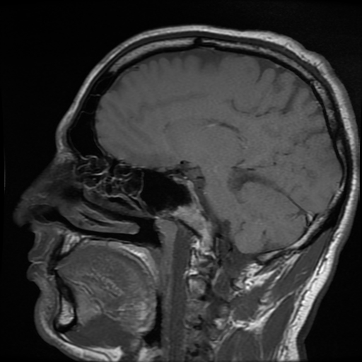 File:Cerebral cavernous venous malformation (Zabramski type II) (Radiopaedia 85511-101198 Sagittal T1 21).jpg