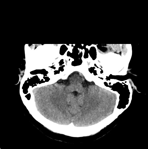 File:Cerebral cavernous venous malformations (Radiopaedia 48117-52945 Axial non-contrast 8).png