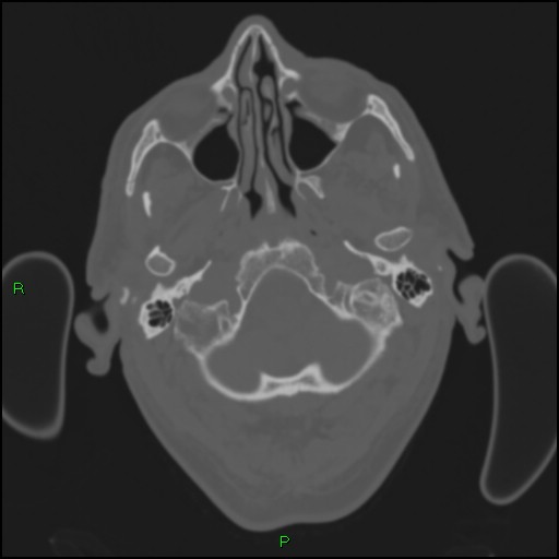 Cerebral contusions (Radiopaedia 33868-35039 Axial bone window 19).jpg