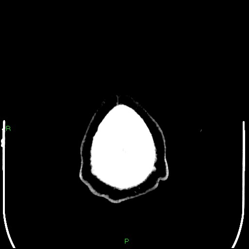 Cerebral contusions (Radiopaedia 33868-35039 Axial non-contrast 218).jpg