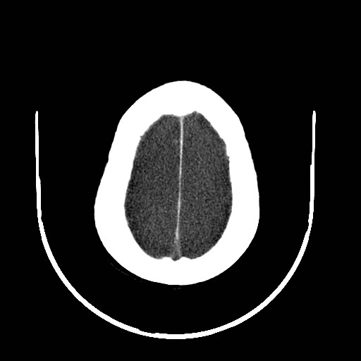 Cerebral edema (evolution in time) (Radiopaedia 19418-19439 non-contrast 80).jpg