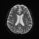 Cerebral embolic infarcts (embolic shower) (Radiopaedia 72391-82921 Axial DWI 18).jpg