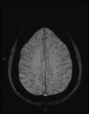 Cerebral fat embolism (Radiopaedia 35022-36525 Axial SWI 43).jpg