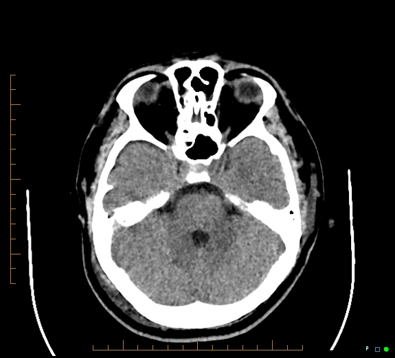 Cerebral fat embolism (Radiopaedia 85521-101220 Axial non-contrast 23).jpg