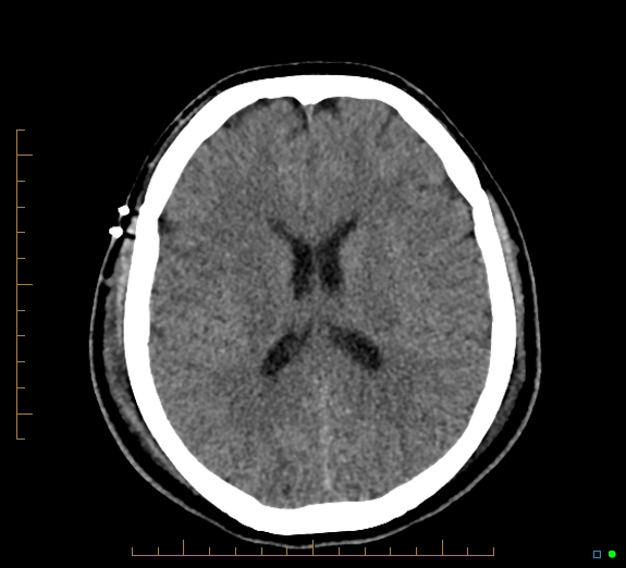 Cerebral fat embolism (Radiopaedia 85521-101224 Axial non-contrast 31).jpg