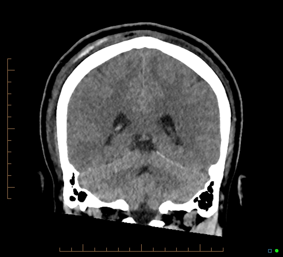 Cerebral fat embolism (Radiopaedia 85521-101224 Coronal non-contrast 43).jpg