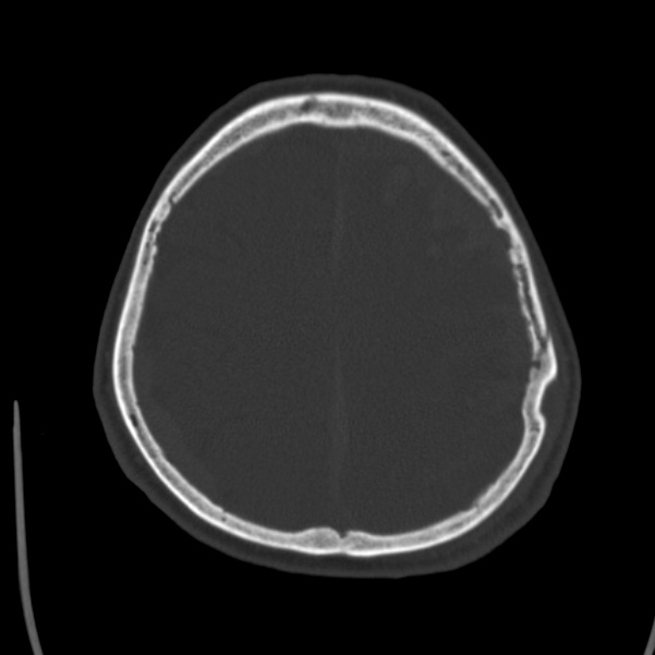 Cerebral hemorrhagic contusions (Radiopaedia 23145-23188 Axial bone window 44).jpg