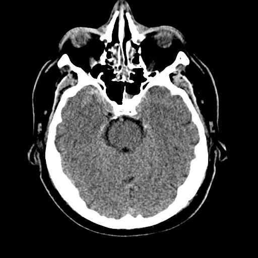File:Cerebral hemorrhagic contusions and cervical spine fractures (Radiopaedia 32865-33841 Axial non-contrast 12).jpg