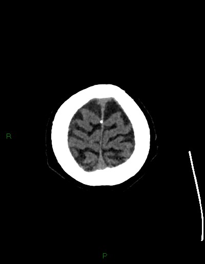 Cerebral metastases - ependymal and parenchymal (Radiopaedia 79877-93131 Axial non-contrast 75).jpg