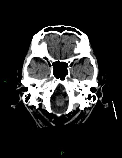 Cerebral metastases - ependymal and parenchymal (Radiopaedia 79877-93131 Axial non-contrast 8).jpg