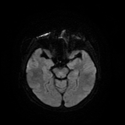 Cerebral metastases - melanoma (Radiopaedia 80972-94522 Axial DWI 13).jpg