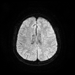 Cerebral metastases - melanoma (Radiopaedia 80972-94522 Axial DWI 20).jpg