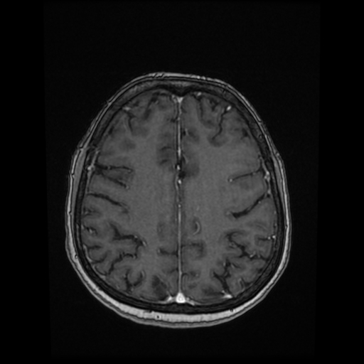 Cerebral metastases - melanoma (Radiopaedia 80972-94522 Axial T1 C+ 68).jpg