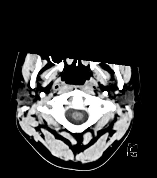Cerebral metastases - testicular choriocarcinoma (Radiopaedia 84486-99855 Axial non-contrast 53).jpg
