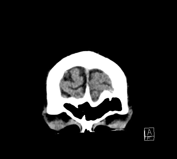 Cerebral metastases - testicular choriocarcinoma (Radiopaedia 84486-99855 Coronal C+ delayed 7).jpg