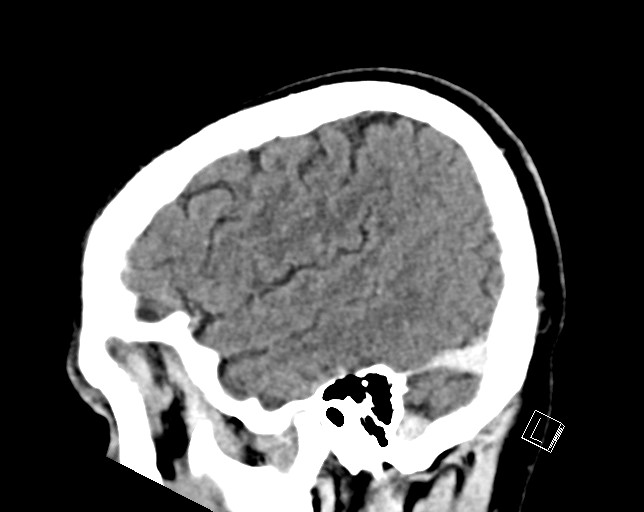 Cerebral metastases - testicular choriocarcinoma (Radiopaedia 84486-99855 F 46).jpg