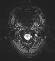 Cerebral metastasis - melanoma (Radiopaedia 54718-60954 Axial SWI 1).png