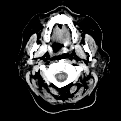 Cerebral metastasis to basal ganglia (Radiopaedia 81568-95412 Axial C+ delayed 5).png