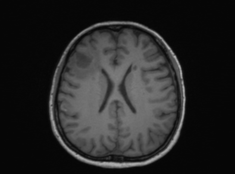 Cerebral ring enhancing lesions - cerebral metastases (Radiopaedia 44922-48817 Axial T1 196).jpg