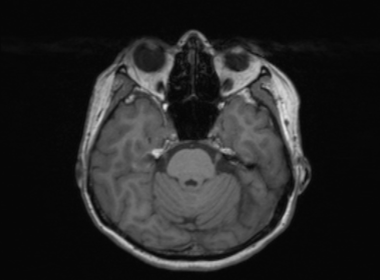 Cerebral ring enhancing lesions - cerebral metastases (Radiopaedia 44922-48817 Axial T1 282).jpg