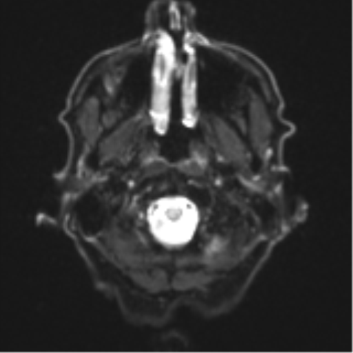 File:Cerebral toxoplasmosis (Radiopaedia 54575-60804 Axial DWI 5).png