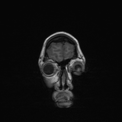 Cerebral tuberculosis with dural sinus invasion (Radiopaedia 60353-68090 Coronal T1 23).jpg