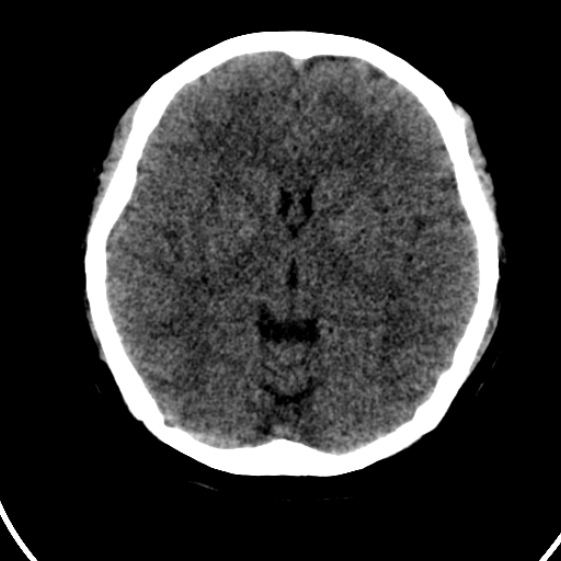 File:Cerebral venous hemorrhagic infarct from venous sinus thrombosis (Radiopaedia 55433-61879 Axial non-contrast 11).jpg