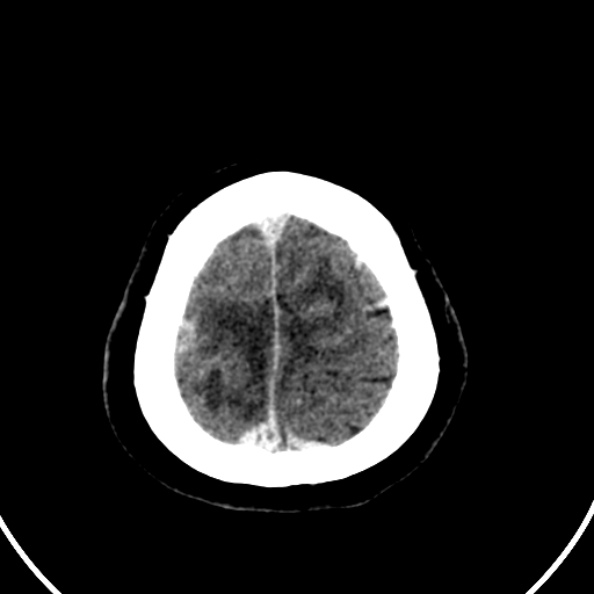 File:Cerebral venous hemorrhagic infarct from venous sinus thrombosis (Radiopaedia 55433-61883 Axial C+ delayed 20).jpg