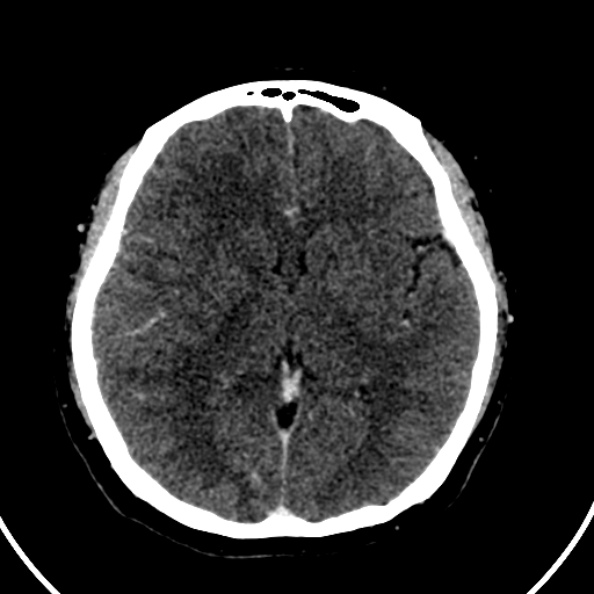 Cerebral venous hemorrhagic infarct from venous sinus thrombosis (Radiopaedia 55433-61883 Axial C+ delayed 75).jpg
