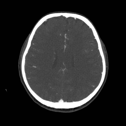 Cerebral venous sinus thrombosis (Radiopaedia 40619-43227 A 147).jpg