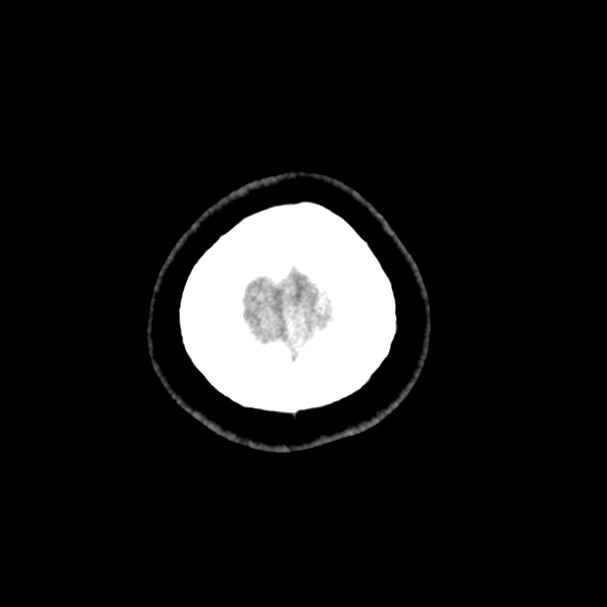 Cerebral venous sinus thrombosis (Radiopaedia 59224-66551 Axial non-contrast 62).jpg