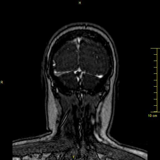 Cerebral venous thrombosis (Radiopaedia 23288-23351 MRV 162).JPG