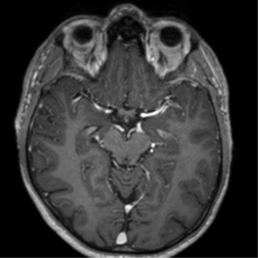 Cerebral venous thrombosis (Radiopaedia 38392-40469 Axial T1 C+ 34).png