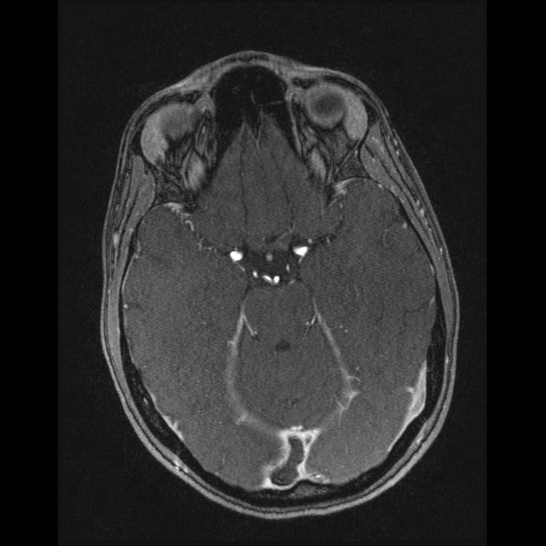 Cerebral venous thrombosis (Radiopaedia 45678-49854 Axial MRV 25).jpg