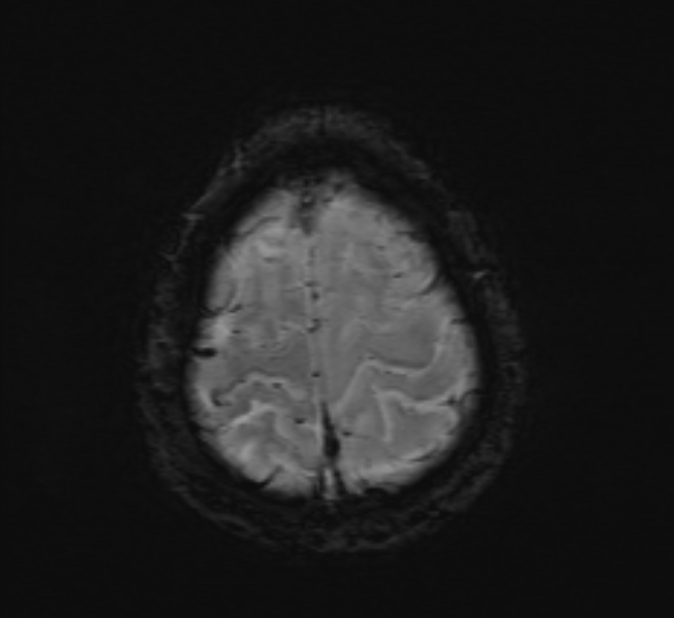 Cerebral venous thrombosis (Radiopaedia 71207-81504 Axial SWI 48).jpg