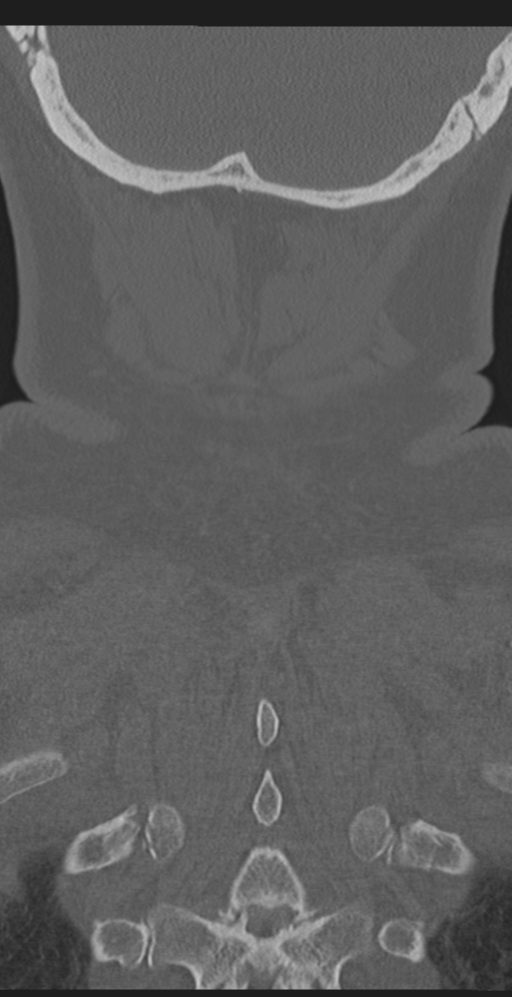 Cervical canal stenosis due to ossification of the posterior longitudinal ligament (Radiopaedia 47260-51823 Coronal bone window 62).png
