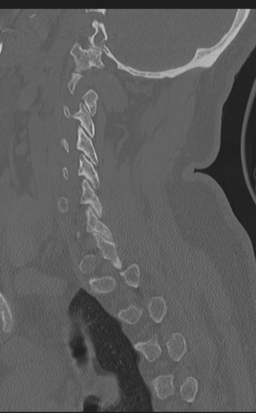Cervical canal stenosis due to ossification of the posterior longitudinal ligament (Radiopaedia 47260-51823 Sagittal bone window 53).png