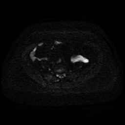 Cervical carcinoma (Radiopaedia 85405-101028 Axial DWI 39).jpg