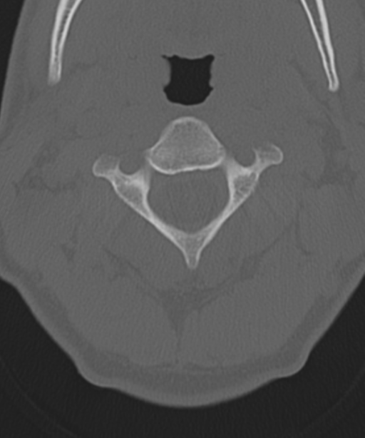 Cervical intercalary bone (Radiopaedia 35211-36748 Axial bone window 20).png