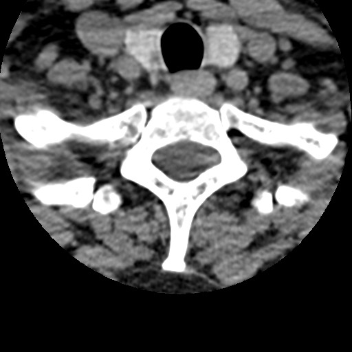 File:Cervical spinal neurofibroma in a patient with NF1 (Radiopaedia 58344-65464 Axial non-contrast 67).jpg