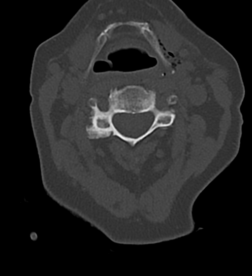 File:Cervical spine ACDF loosening (Radiopaedia 48998-54070 Axial bone window 25).png