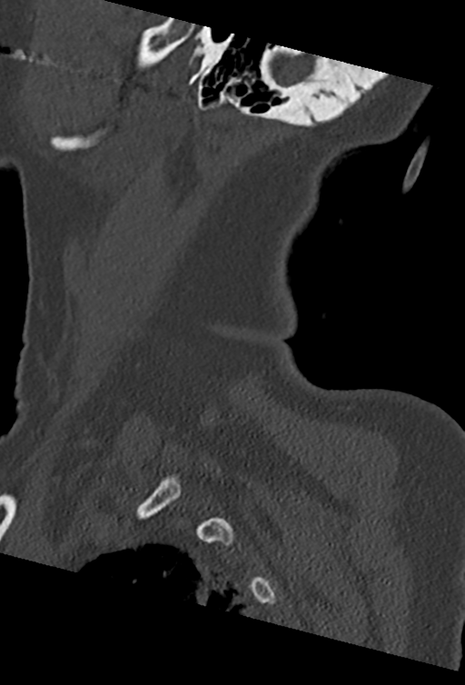 Cervical spine ACDF loosening (Radiopaedia 48998-54070 Sagittal bone window 76).png