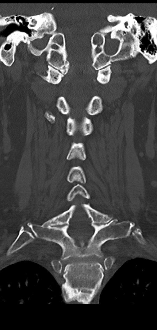Cervical spine fracture - chalk stick (Radiopaedia 39116-41323 Coronal bone window 29).png