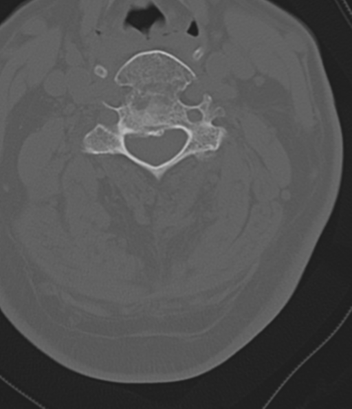 File:Cervical spine fracture in the setting of ankylosis (Radiopaedia 37038-38715 Axial bone window 29).png