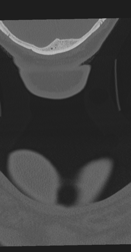 Cervical spine fracture in the setting of ankylosis (Radiopaedia 37038-38715 Coronal bone window 89).png