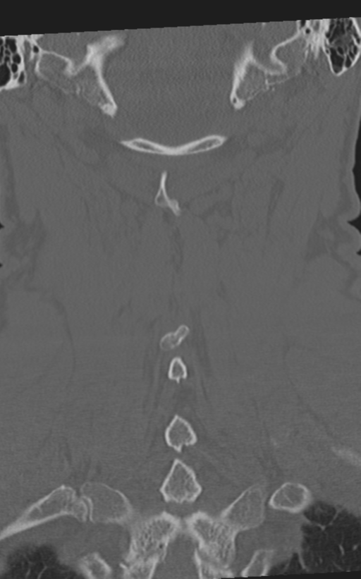 Cervical spine fractures with vertebral artery dissection (Radiopaedia 53296-59268 Coronal bone window 54).png