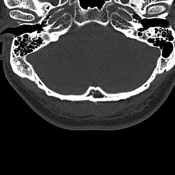 Cervical spondylodiscitis (Radiopaedia 28057-29489 Axial bone window 6).jpg