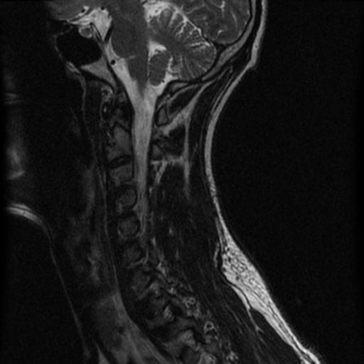 File:Cervical vertebrae metastasis (Radiopaedia 78814-91667 Sagittal T2 4).png