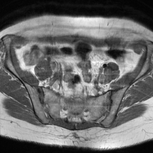 File:Cesarian section scar endometriosis (Radiopaedia 66520-75799 Axial T1 3).jpg
